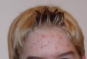 acne mark on forehead